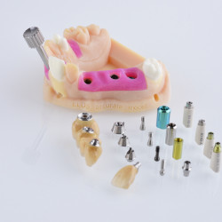 3D-printing and digital models in the dental industry