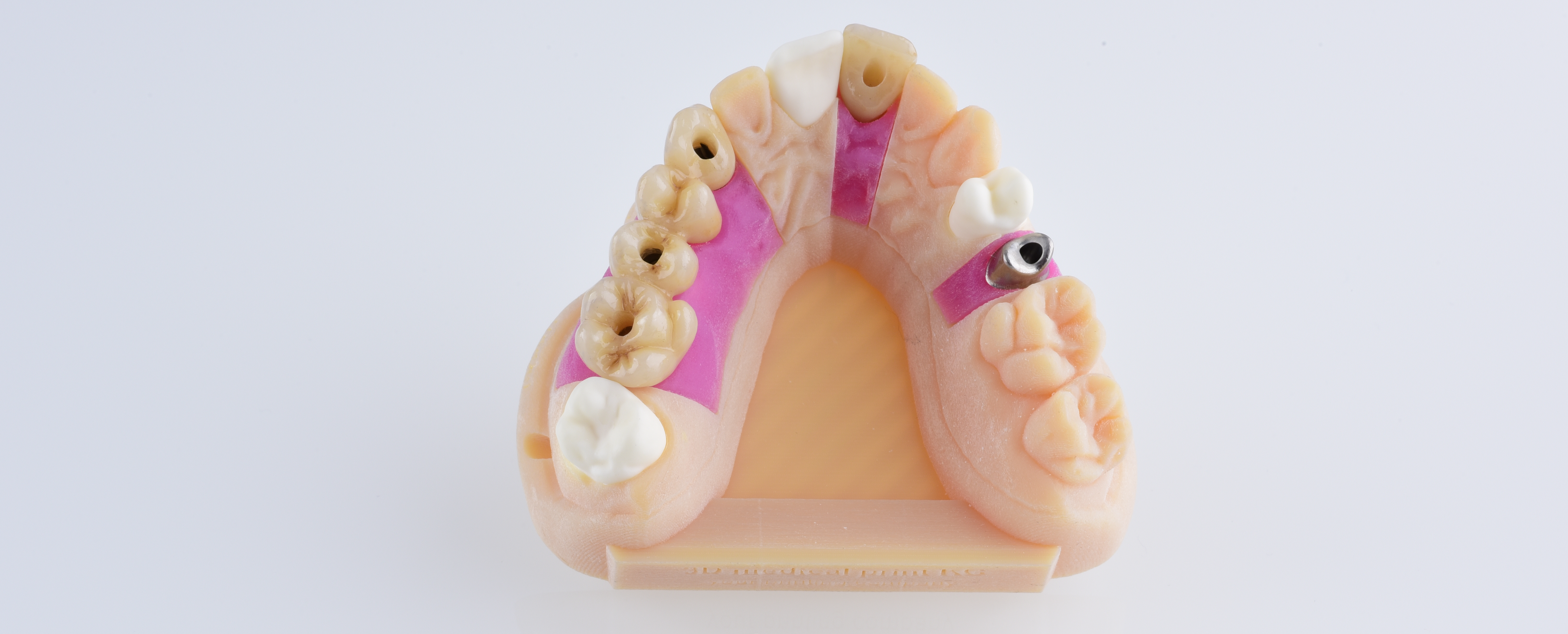 Great benefits of using 3D-printing and digital models in the dental  industry - Elos Medtech
